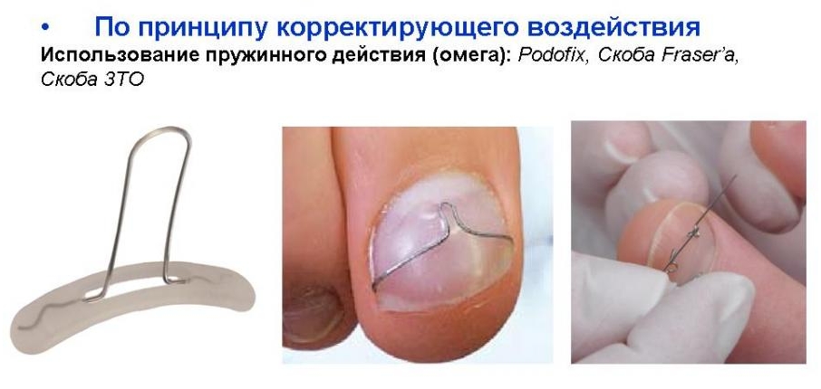 Принцип действия и классификация систем коррекции вросшего ногтя